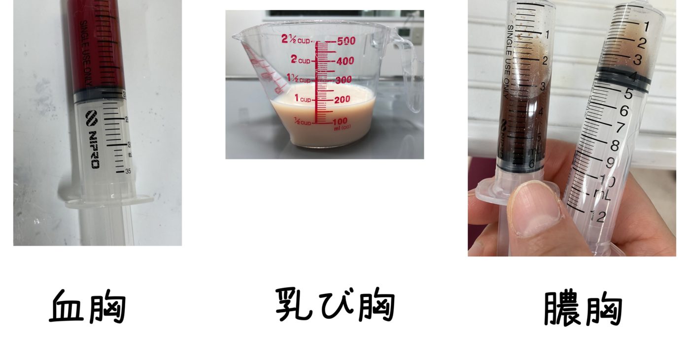 実際に抜いた胸水の色の違い。左から血胸、乳び胸、膿胸