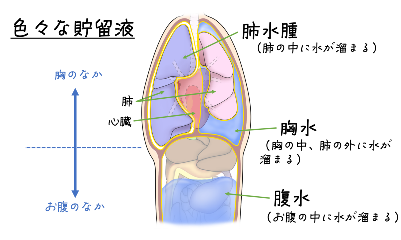 色々な貯留液の図解。肺の中に溜まるのが肺水腫、胸の中で肺の外に溜まるのが胸水、お腹の中に溜まるのが腹水